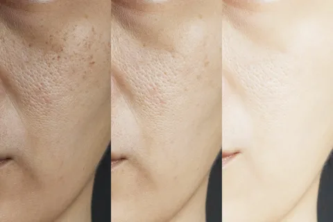 How to Close Pores After Waxing