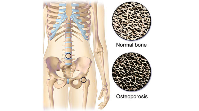 Symptoms and Diagnosis of Osteoporosis
