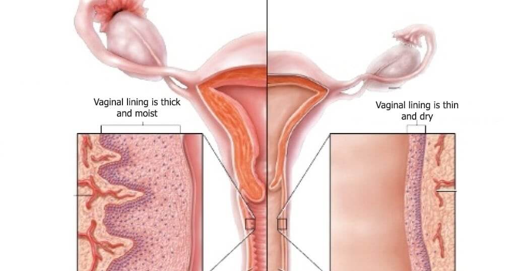 Symptoms of Vaginal Atrophy