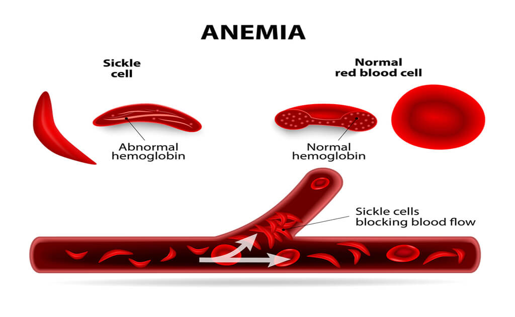 What is Anemia and What Causes it in Women