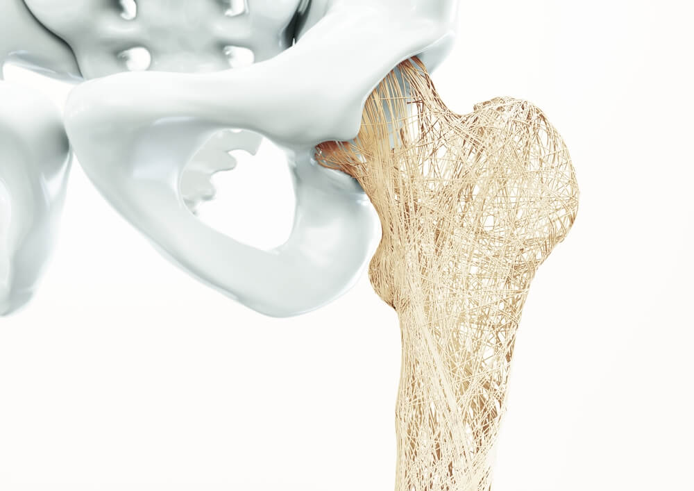 What is Osteoporosis and What Causes It